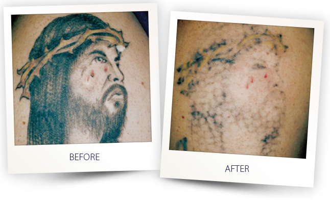 Tattoo Removal (3)