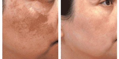 Tattoo-Removal-before-&-after