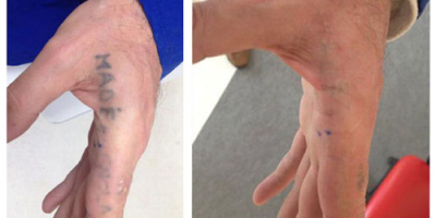 Tattoo-Removal-before-&-after-1
