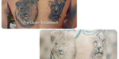 Tattoo-Removal-before-&-after-3