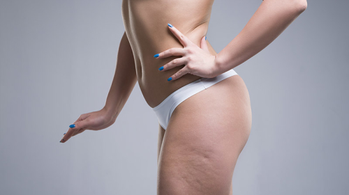 The Ultimate Guide to Eradicate Cellulite