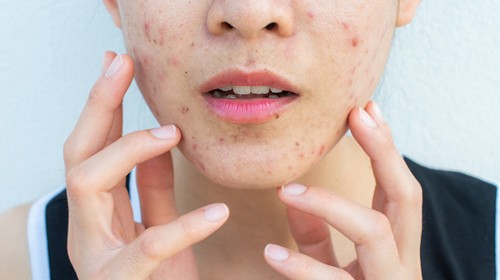 5 acne myths you need to stop believing!