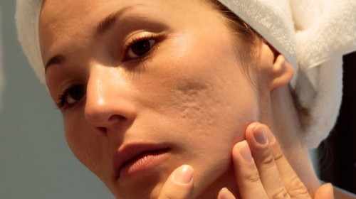 How-to-treat-deep-pitted-acne-scars