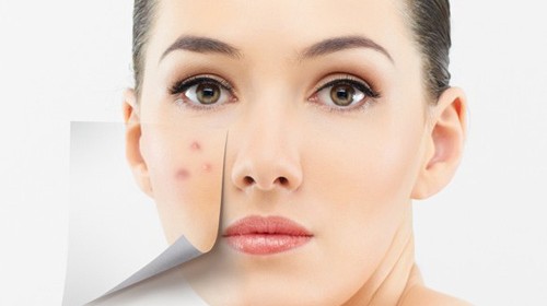 Ways To Treat Your Acne According To Chinese Medicine