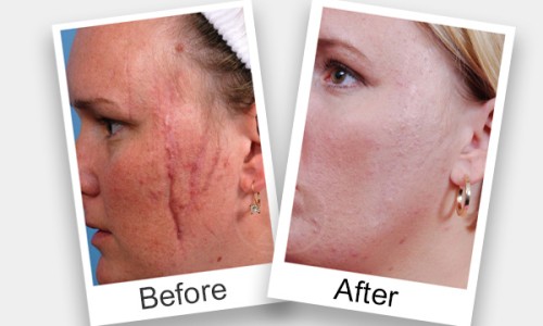 Scars Removal Treatment