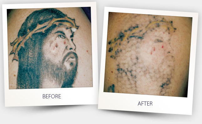 Tattoo removal before&after