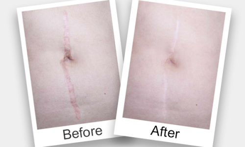Scars Removal Treatment