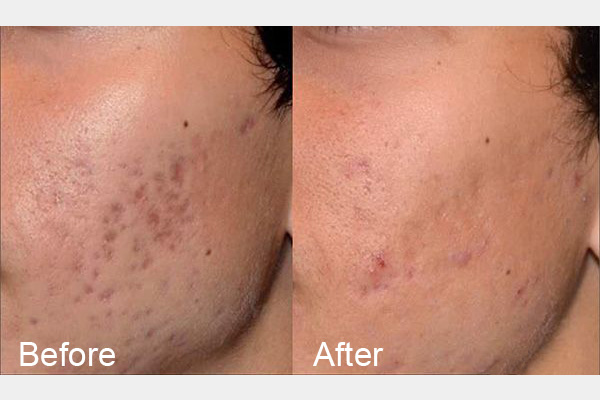 Acne before & after