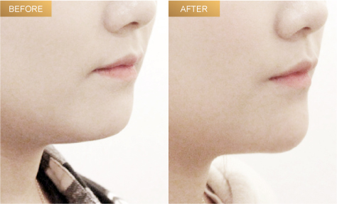filler chin 玻尿酸下巴