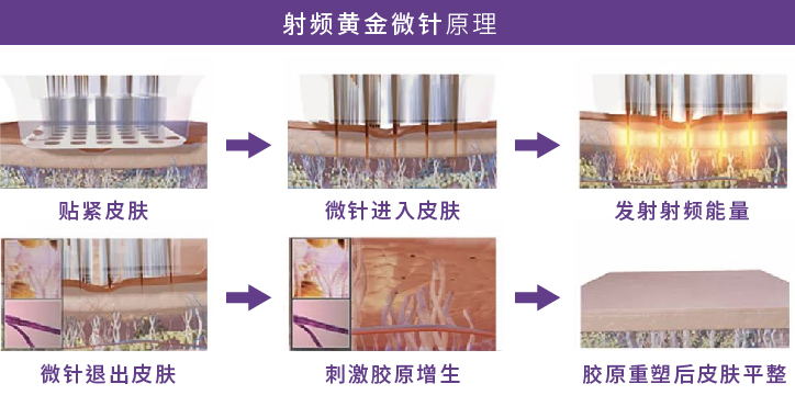射频黄金微针 射频黄金微针