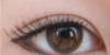 內眥開大(開眼頭)